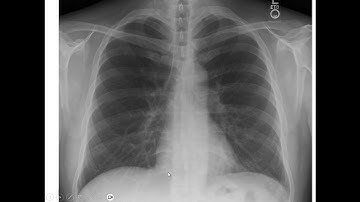 2 - Chest X ray Projections