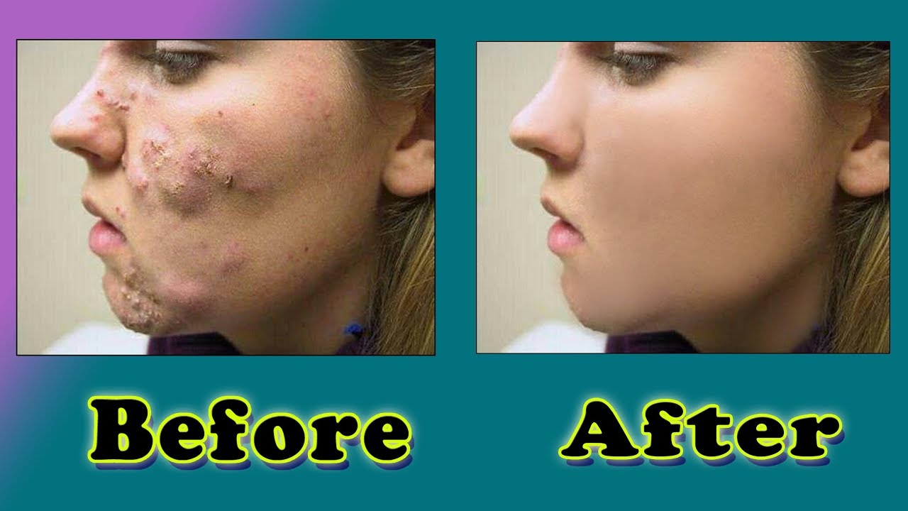 How to remove pimples in Photoshop without any filter | Shahzada Editor