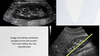 Renal Duplex on Virtual Vascular Lab Channel