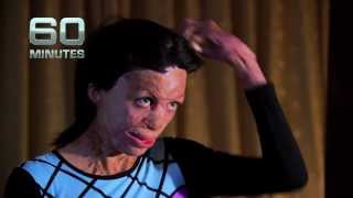 Turia Pitt 60 Minutes