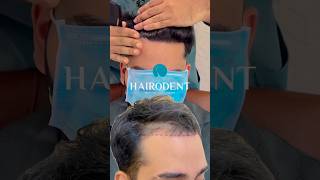 2200 ഗ്രാഫ്റ്റ് ചെയ്തു 6 മാസം കഴിയുമ്പോൾ ✅ #drsreenath #hairodent #hairtransformation
