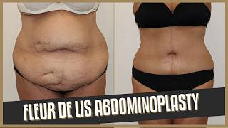 Fleur-De-Lis Tummy Tuck (Abdominoplasty)