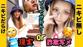 【大量ニキビ】現役モデル。実際どっちが可愛い！？