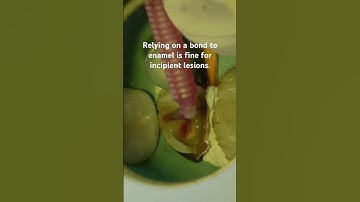 Immediate Dentin Sealing for Deep Caries