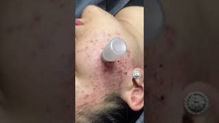 Satisfying Relaxing with Vien Tham My DrAZI  #acne #pimples #blackheads