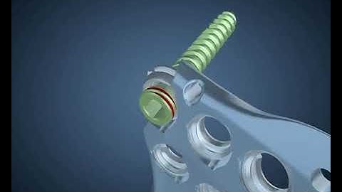 Dualtec System® 2
