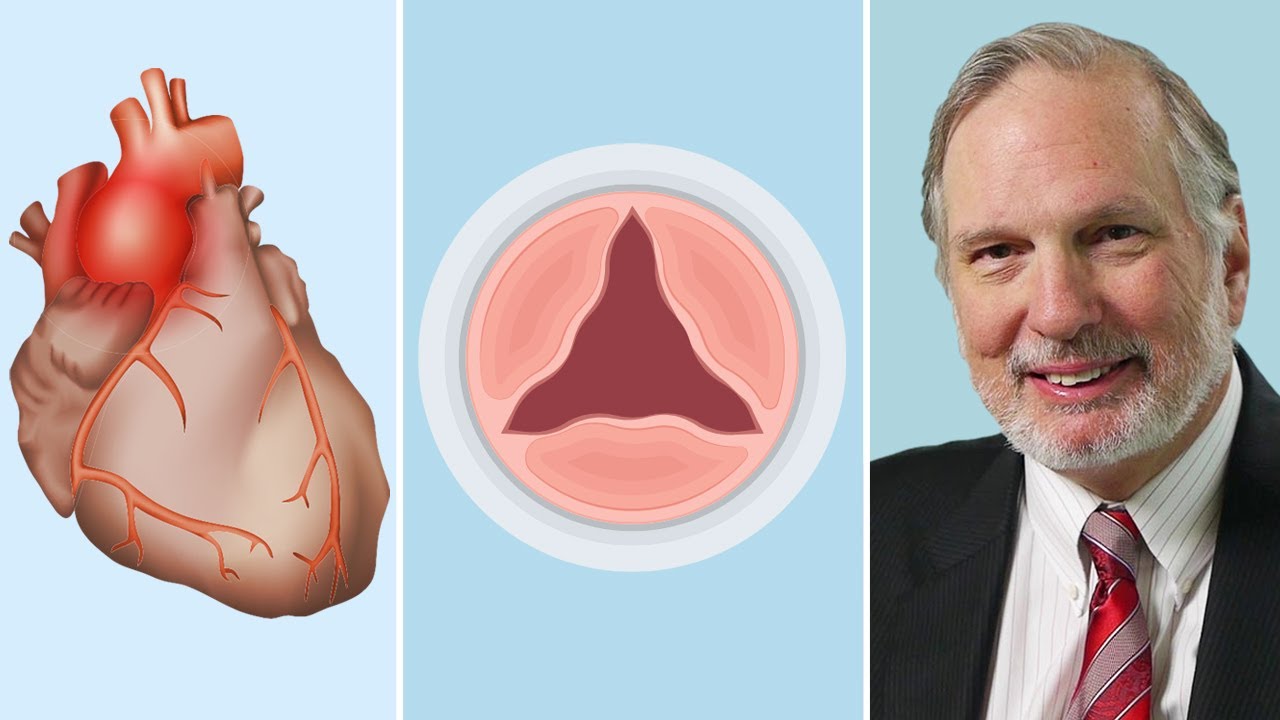 Aortic Valve Disease  Aortic Aneurysms: What Should Patients Know? (With Dr. Joseph Bavaria)