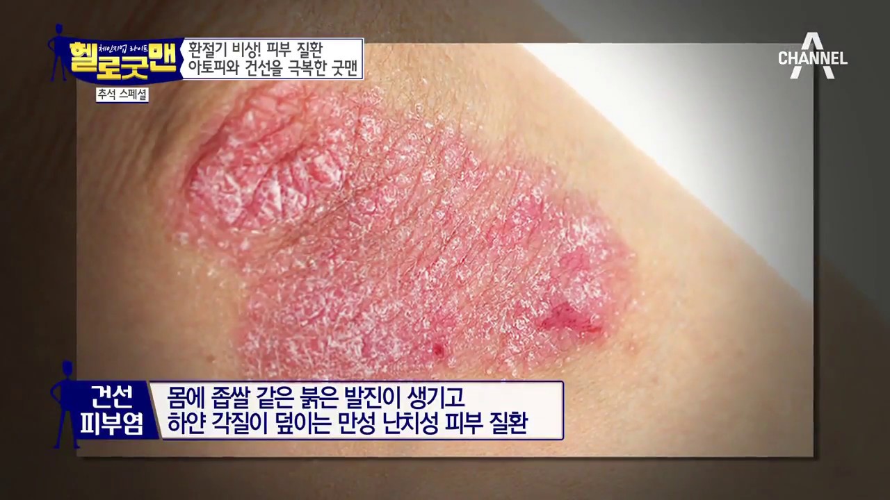 환절기 비상! ‘피부질환’ 아토피와 건선 피부염을 극복한 굿맨의 비법!