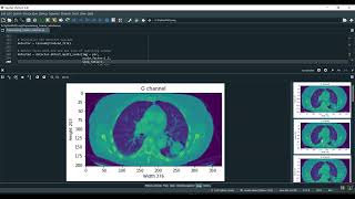 Lung Cancer Feature Extraction in Python Projects