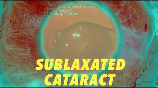 Subluxated traumatic nigra cataract