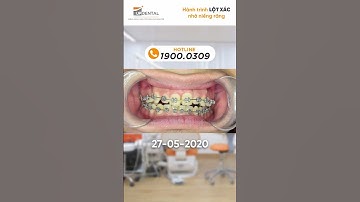 Hành trình LỘT XÁC nhờ niềng răng của Minh Kiệt