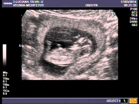 ecografia bebe 9 semanas diabetes gestacional ecografia bebe 9 semanas diabetes gestacional