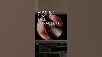 FUNGUS BALL EXTRACTION 🦠🥼#breathebetter #sinusitis #fungus #snot #entsurgeon #allergies #surgery