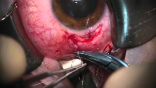 Resident Open Globe Repair From Cut-Like Dart Injury