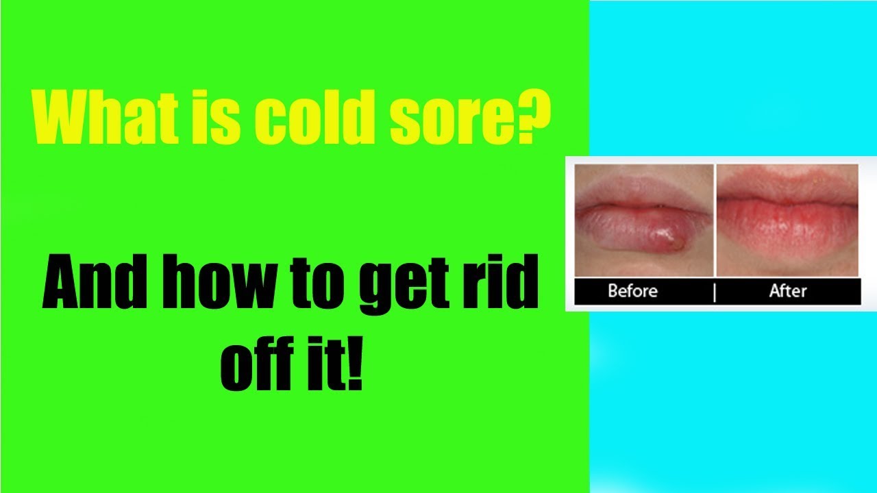  What Is Cold Sore And How To Get Rid Off It Naturally 2020 YouTube