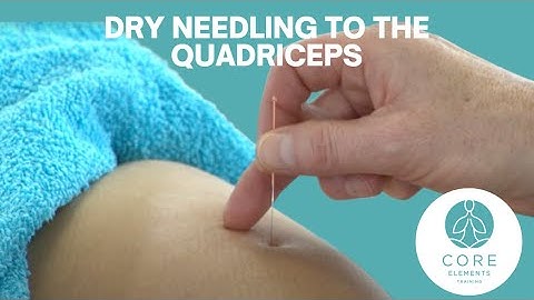 Dry Needling Techniques to the Quadriceps region