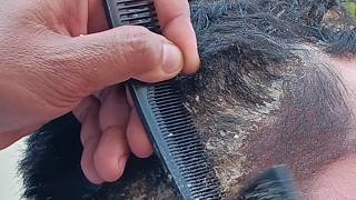 ASMR Scalp Scratching Sounds to Help You Fall Asleep #106