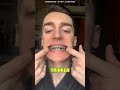 Wie Zahnspangen wirklich arbeiten 🦷😫#lustig #funny