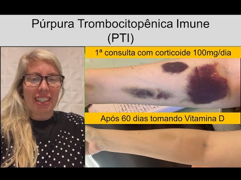 Aline - Púrpura Trombocitopênica Imune (PTI)