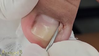 ?TRANSFORMAÇÃO (unha completamente encravada)│Recuperação inacreditável ?CLASSICO nails satisfying