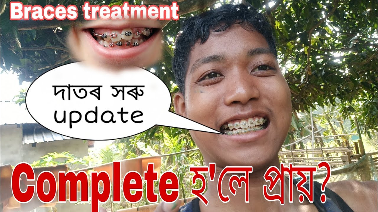 Braces treatment After 1 Years Braces treatment at Goalpara Assam