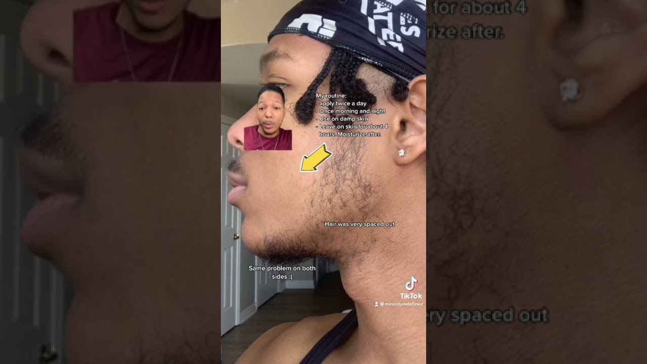 1 месяц пути к бороде с миноксидилом