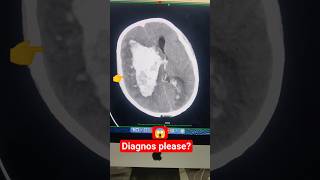 DIAGNOS PLEASE #critical #MEDIACAL #emergency #BRAIN #stroke #radiology #ct
