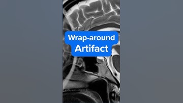 MRI Wrap-Around Artifact in 76 seconds – Why It Happens and How to Fix It