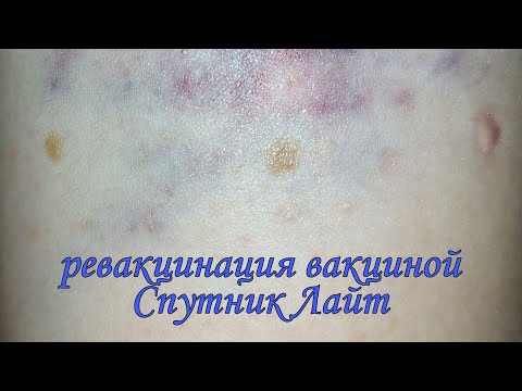 Осложнение после подкожной инъекции. Ревакцинация от COVID-19 вакциной Спутник Лайт.