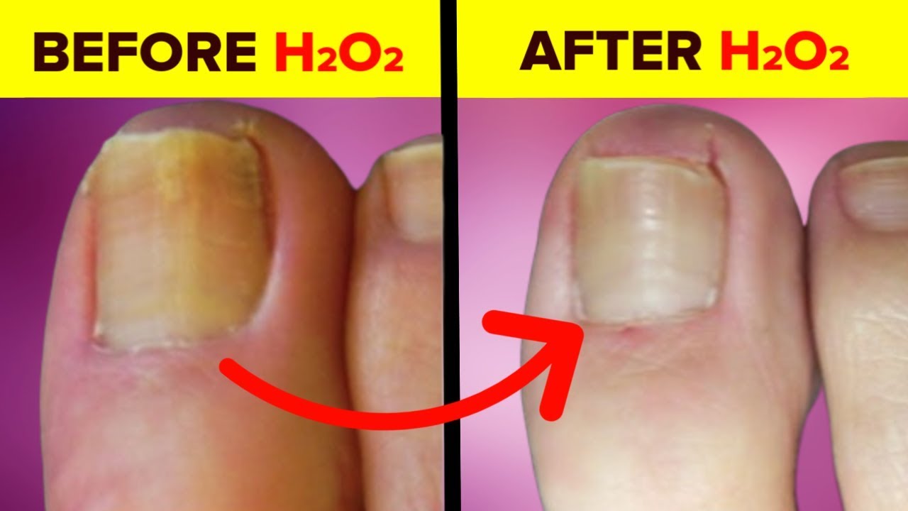 Treat Nail Fungus with Hydrogen Peroxide - HINT: Soak Your Feet & Hands -  YouTube