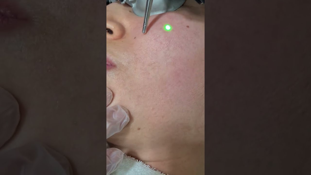 Yüzdeki Kılcal Damar Tedavisi Dr. Okan DOST