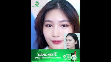 ✨ Chào đón chiếc mũi cao xinh sau 7 ngày nâng mũi!!!!