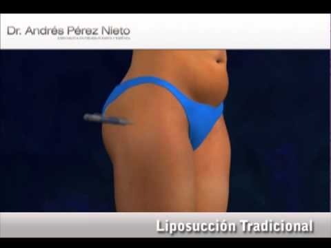video editing software free traditionalLipo es 3