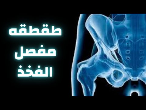 طقطقه مفصل الفخذ طقطقه مفصل الورك طقطقة مفصل الحوض علاج طقطقه مفصل الورك دكتور احمد حسن جمعه