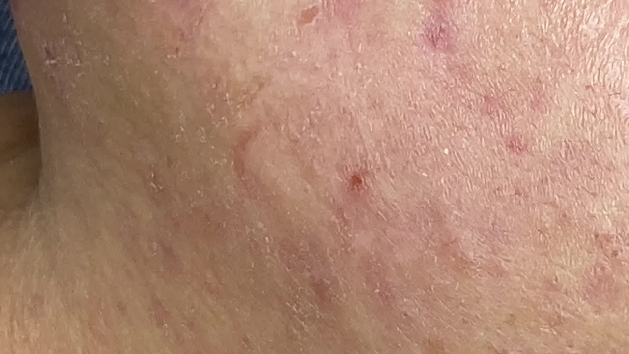 Acne Vulgaris | Mụn Trứng Cá - SacDepSpa#156