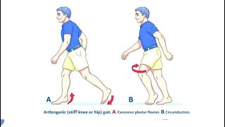 Arthrogenic Gait (Stiff Hip, Knee Gait); abnormal walking, Joint becomes stiff, painful, or fused screenshot 2