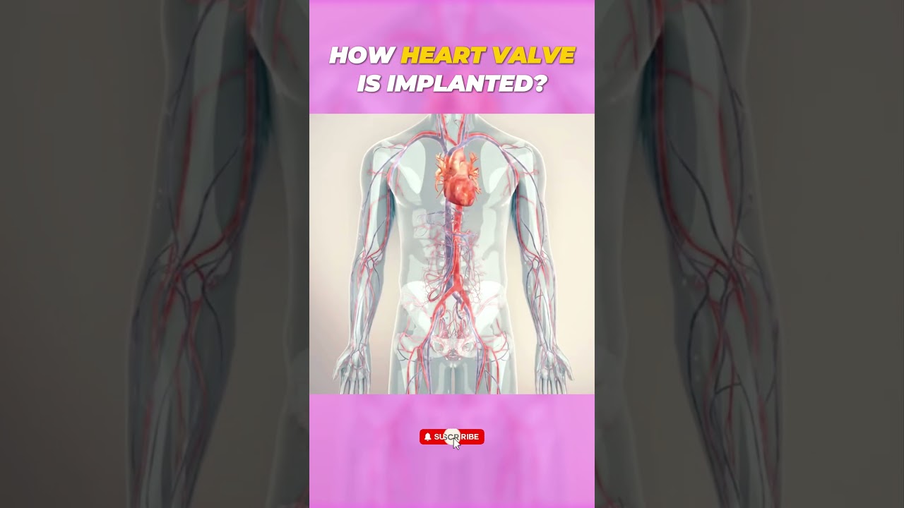 Heart Valve Implant | 3D Surgery Animation | TAVR vs Open-Heart Explained 