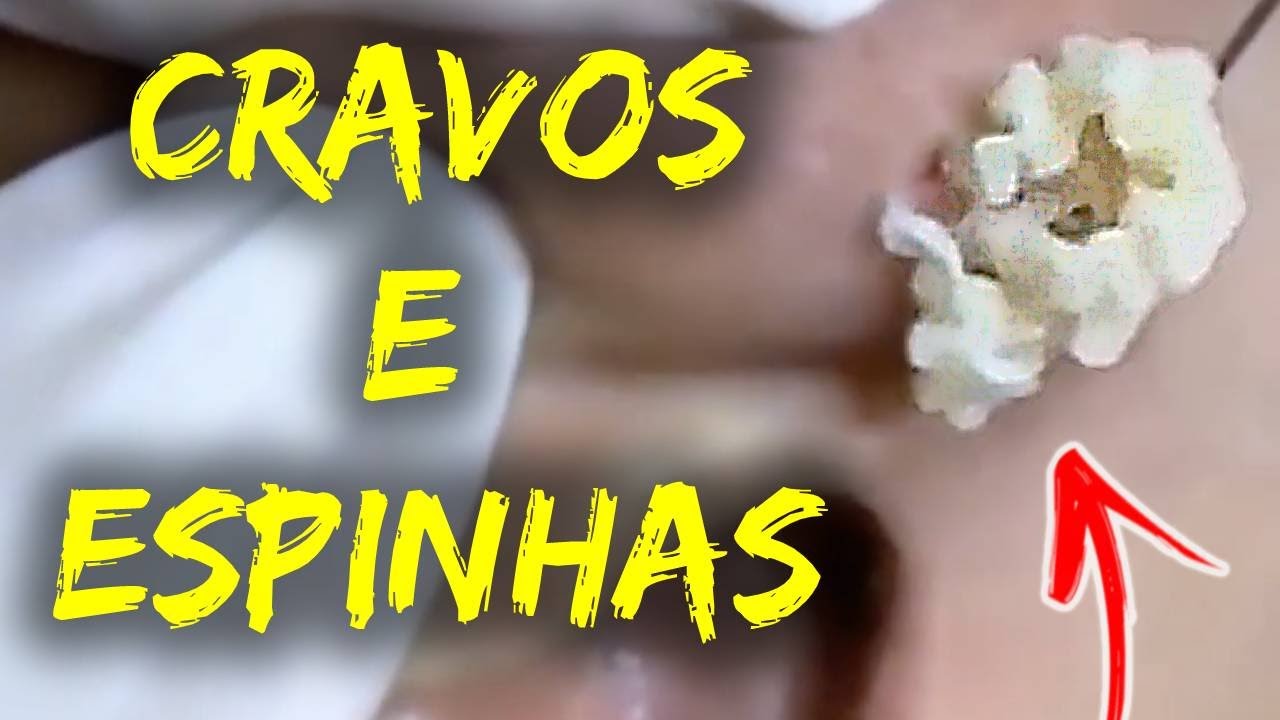 Como Remover Cravos do Rosto Removendo CRAVOS e ESPINHAS GIGANTES