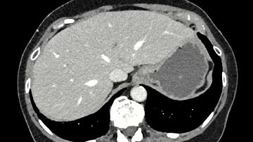 intestinal malrotation on CT