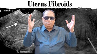 Uterus Fibroids / Dr.C.K.Nandagopalan
