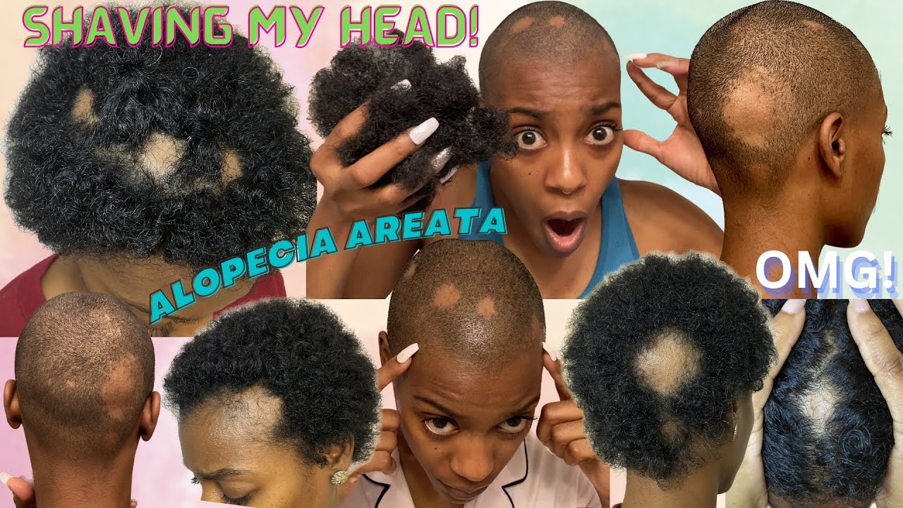 I SHAVED MY HEAD! Shaving All My Hair Off, Alopecia Areata, Hair Loss ...