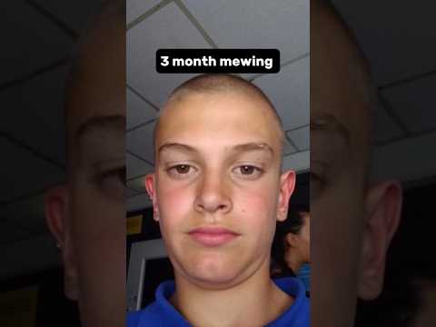 3 months mewing transformation 🔥