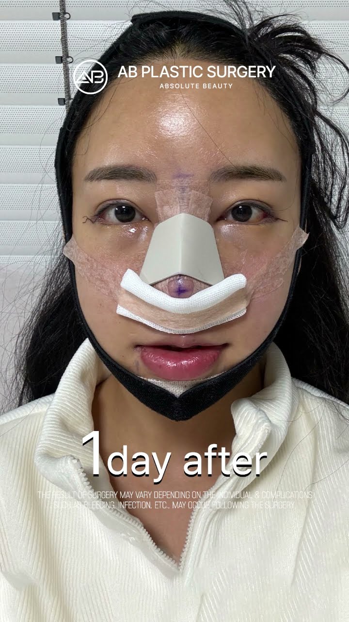 [Plastic Surgery in Korea] Facial Contouring Surgery + Revision Rhinoplasty Review