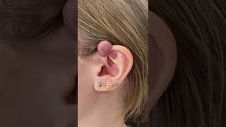 Amazing results! #keloidremoval #keloid #plasticsurgery #cystremoval #moleremoval