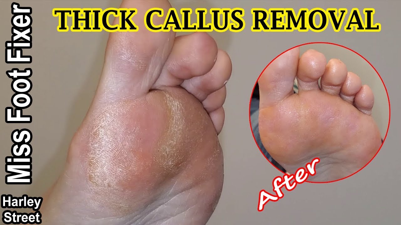 Callus Removal Extra Thick Foot Calluses