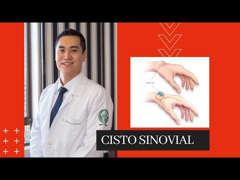Cisto Sinovial