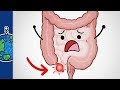 Appendicitis Causes and Trends