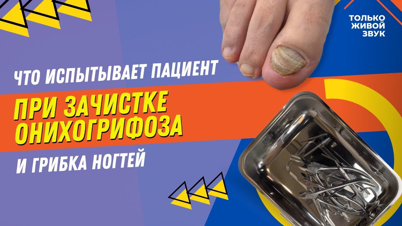 Что испытывает пациент при зачистке онихогрифоза и грибка ногтей ...