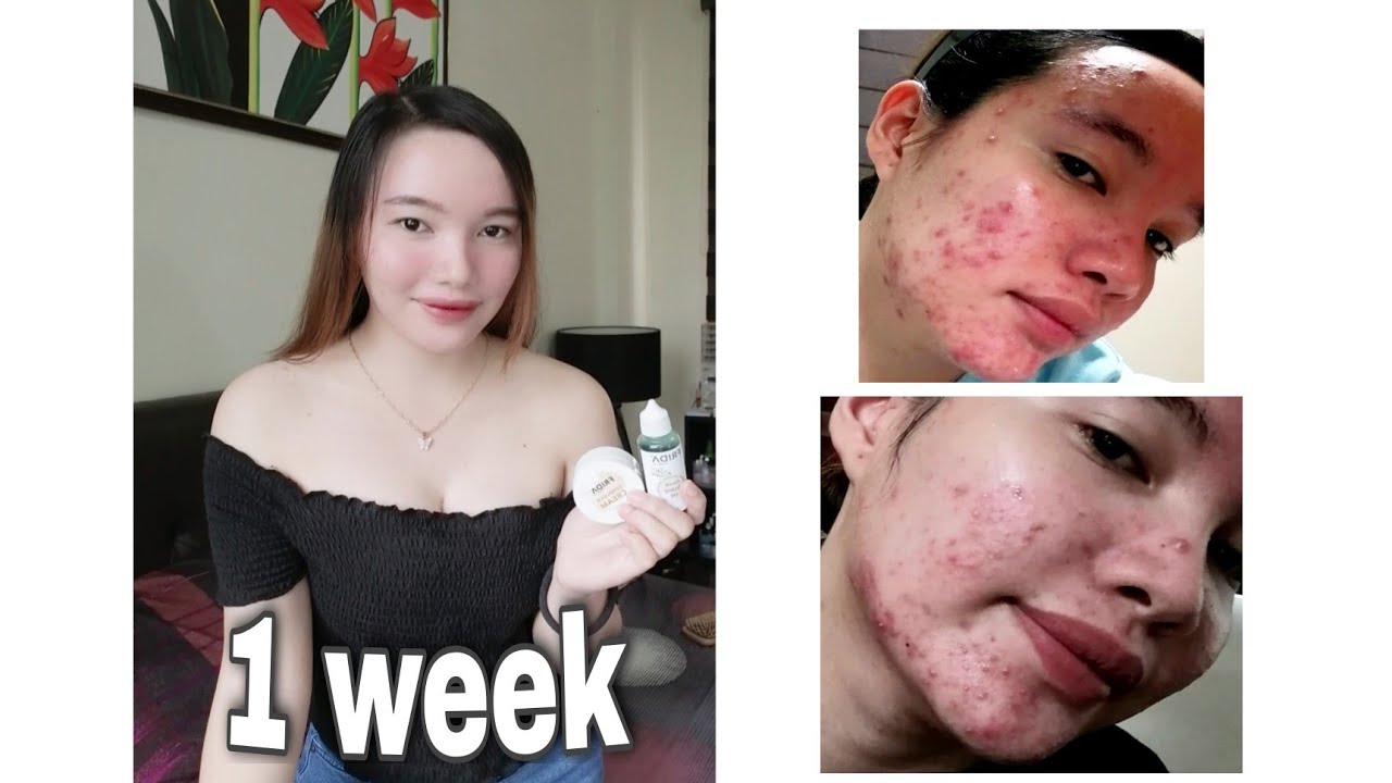 HOW I CLEARED MY SKIN?? | Using 2 Products only (Acne Journey) - YouTube