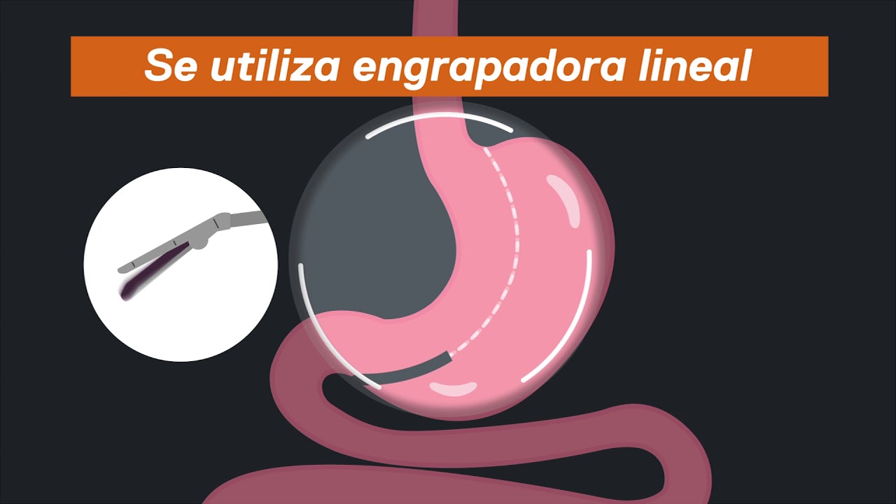 CIRUGIA MANGA GASTRICA  I  EXPERIENCIA ENDOMETABOLIC